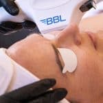 BBL Laser Therapy results Tucson