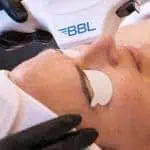 BBL Laser Therapy results Tucson