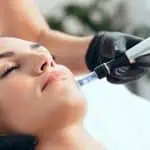 Microneedling before and after Tucson