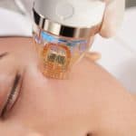 RF Microneedling results Tucson