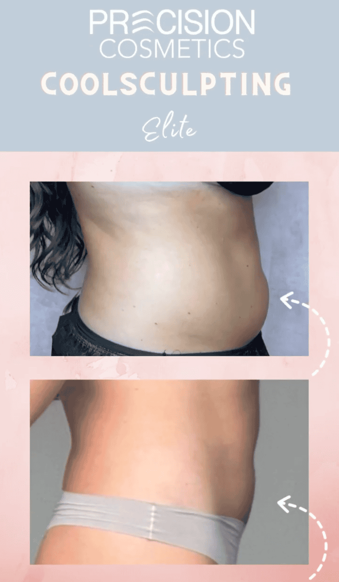 Precision Cosmetics CoolSculpting Tucson