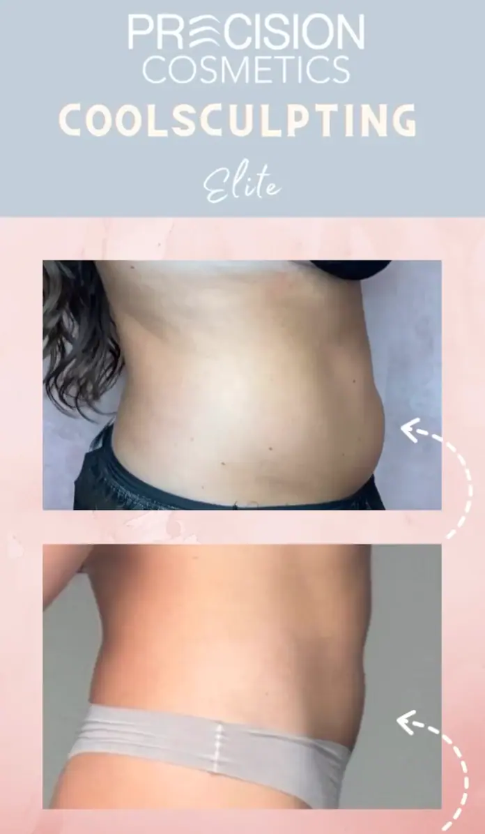 Precision Cosmetics CoolSculpting Tucson