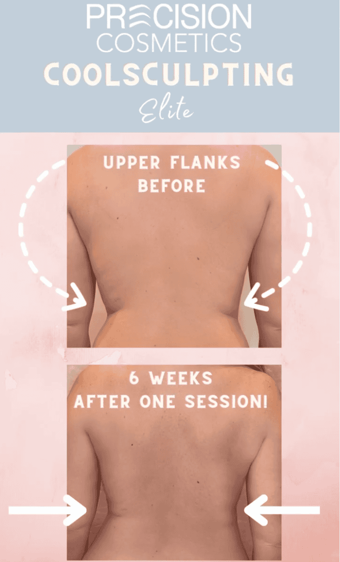 Non-invasive fat reduction CoolSculpting Tucson
