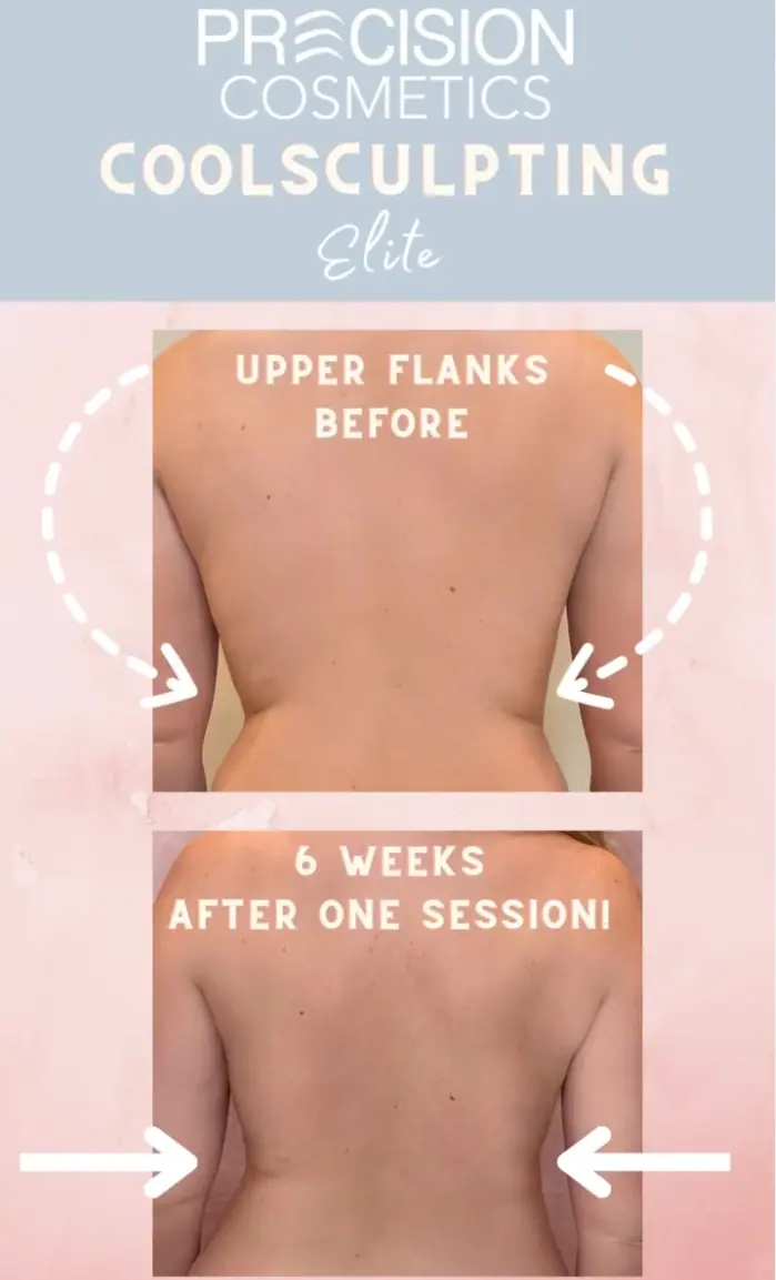 Non-invasive fat reduction CoolSculpting Tucson