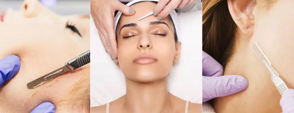 Dermaplaning treatment in Tucson