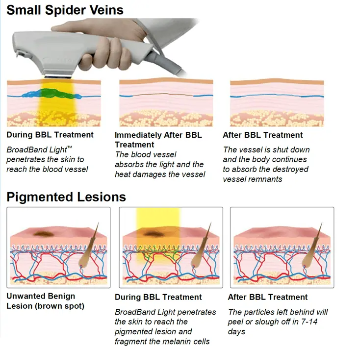 Precision Cosmetics BBL laser treatment Tucson